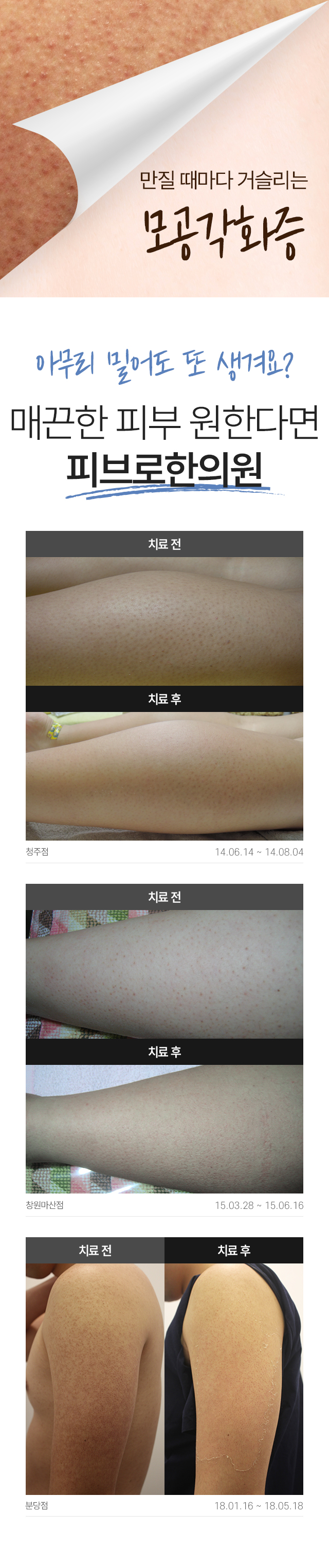 모공각화증 치료